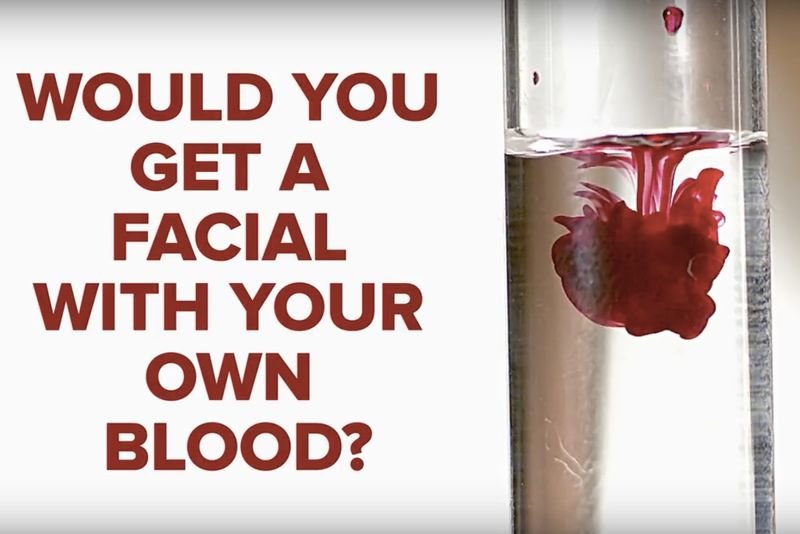 Video: Getting A Blood Facial 1