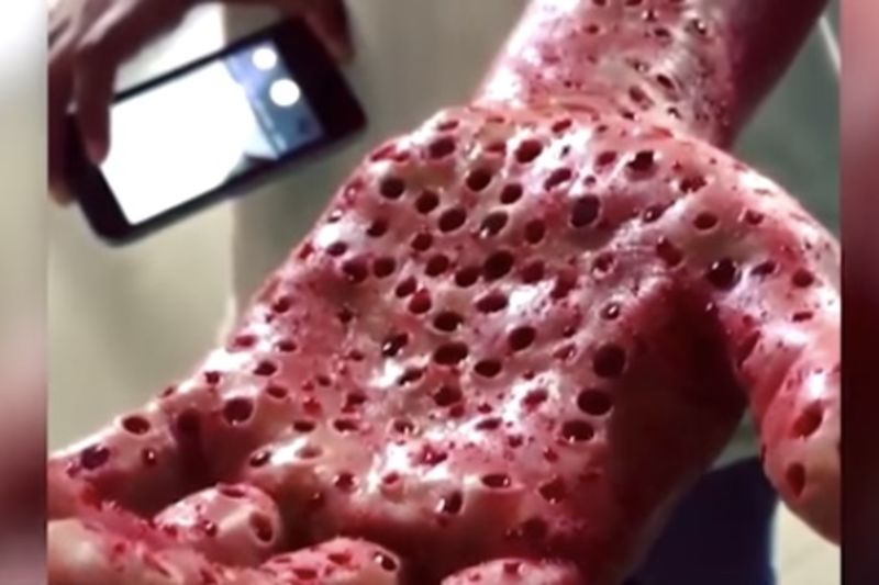 Video: Worms That Belong In Nightmares Could Be Feeding On Your Flesh! 1