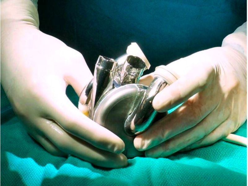 First Ever Titanium Heart Has Successfully Been Implanted Into a Human 1