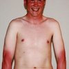 Video: No, Your Oozing, Peeling Sunburn Will Not Make You Into A Golden Godess