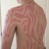Video: No, Your Oozing, Peeling Sunburn Will Not Make You Into A Golden Godess