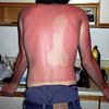 Video: No, Your Oozing, Peeling Sunburn Will Not Make You Into A Golden Godess